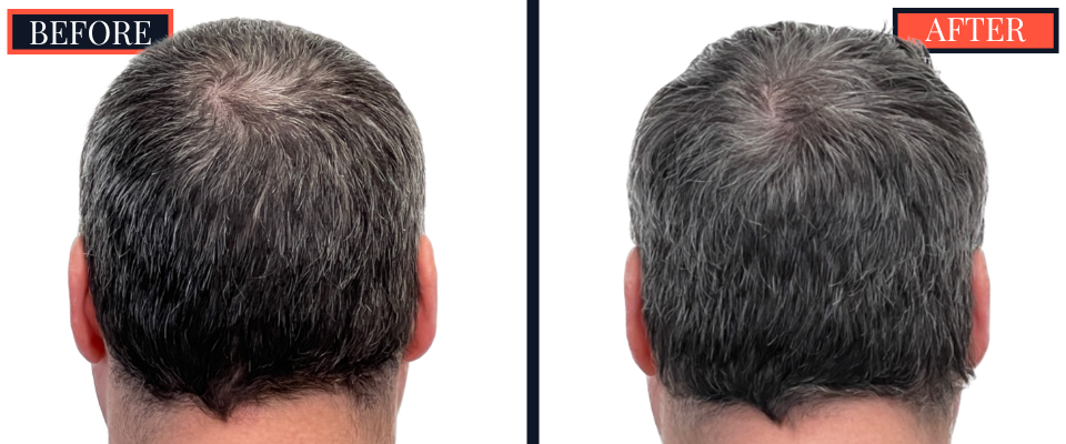 2354 GRAFT FUE HAIR TRANSPLANT - 1 YEAR POST-OP RESULTS