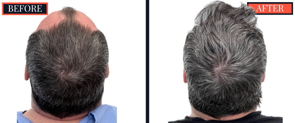 2354 GRAFT FUE HAIR TRANSPLANT - 1 YEAR POST-OP RESULTS