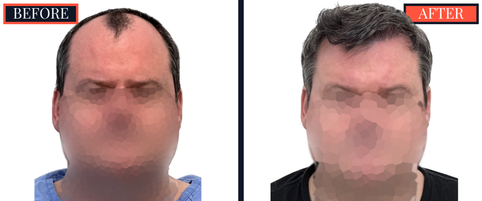 2354 GRAFT FUE HAIR TRANSPLANT - 1 YEAR POST-OP RESULTS