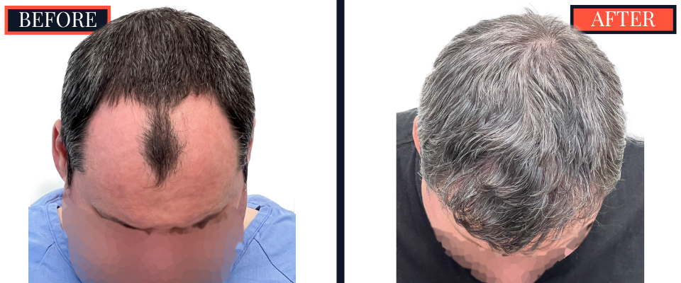 2354 GRAFT FUE HAIR TRANSPLANT - 1 YEAR POST-OP RESULTS