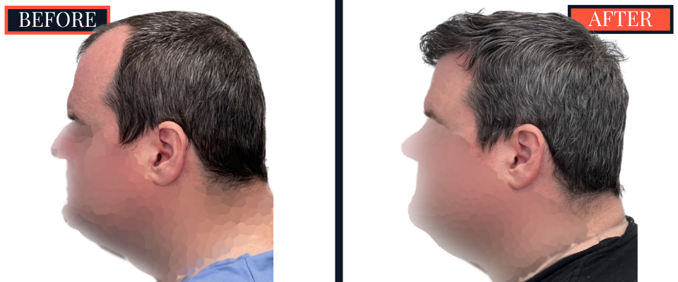 2354 GRAFT FUE HAIR TRANSPLANT - 1 YEAR POST-OP RESULTS
