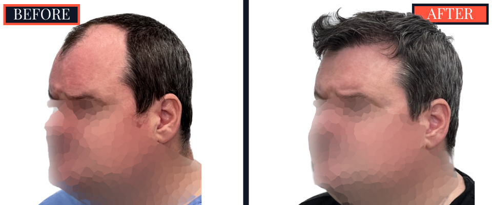 2354 GRAFT FUE HAIR TRANSPLANT - 1 YEAR POST-OP RESULTS