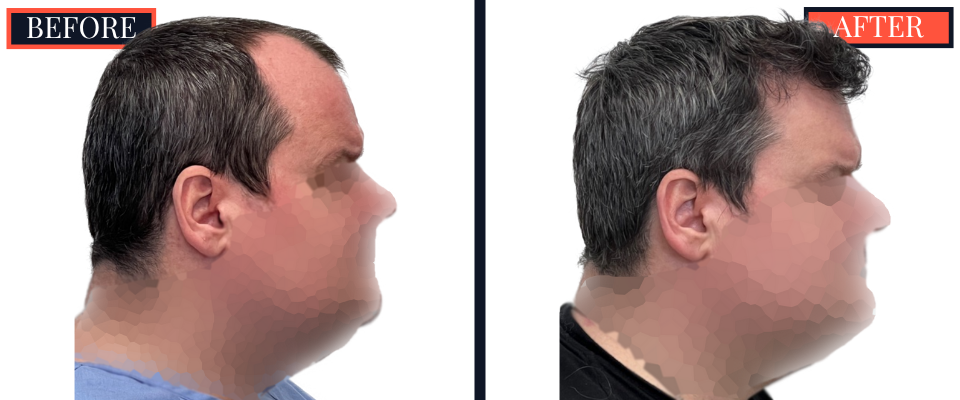 2354 GRAFT FUE HAIR TRANSPLANT - 1 YEAR POST-OP RESULTS