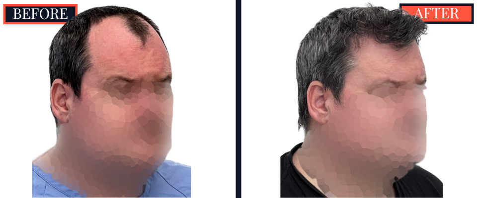 2354 GRAFT FUE HAIR TRANSPLANT - 1 YEAR POST-OP RESULTS