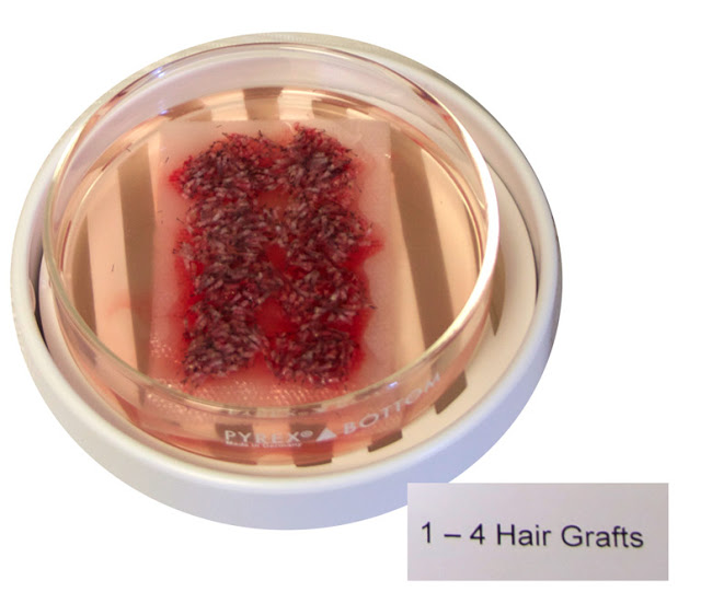 Close Up Grafts for Hair Transplant