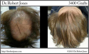 3400 Graft Male Hair Restoration Before and After