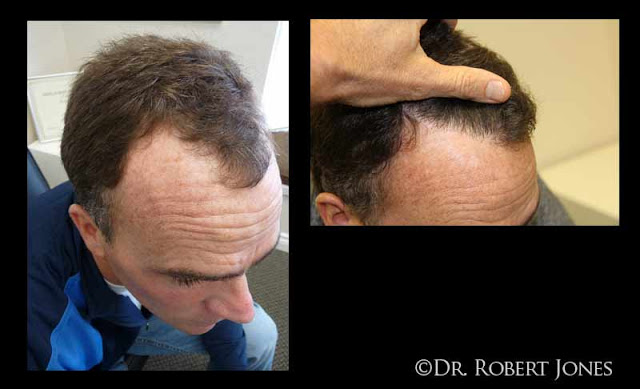 40 Year Old Male FUE Case
