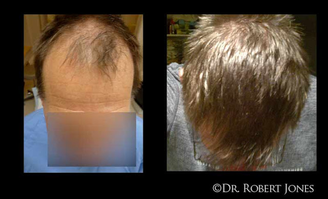 4025 Grafts – Hair Restoration