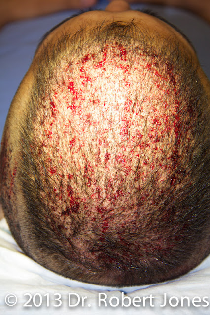Close Up FUE Treatment After a Long Day
