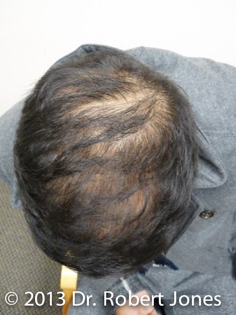 Graft for FUE Hair Transplant