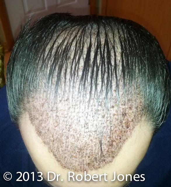 Hairline Treatment - After Surgery