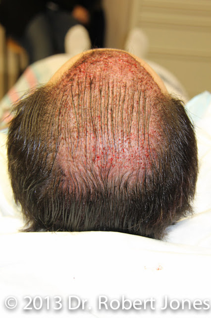 Hairline Treatment - The Results of a Full Day of Surgery