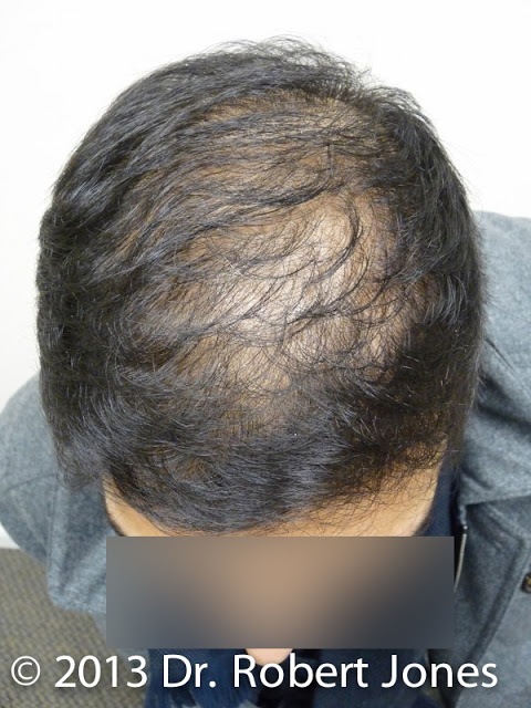 Male FUE Hair Transplant Surgery