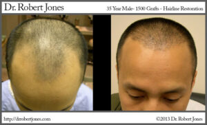 1500 Grafts Hairline Restoration Before and After