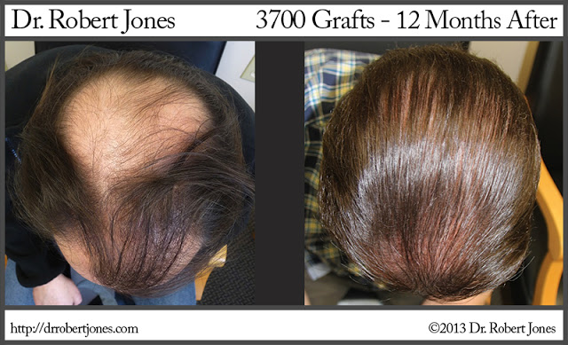 3700 Graft FUE Procedure 12 Month After