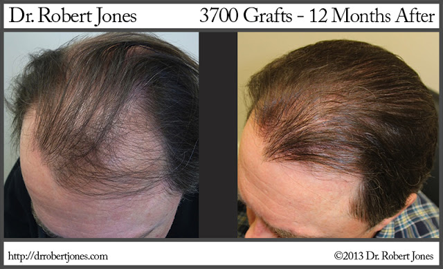 3700 Graft FUE Procedure