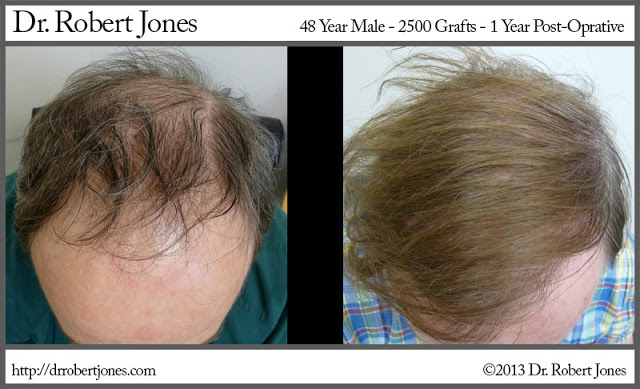 Amazing Hairline Restoration with 2500 Grafts Transplant Procedure |   Jones
