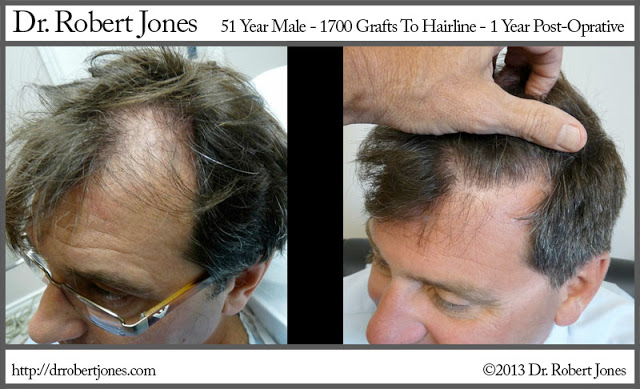 51 Year Old Male - 1700 Grafts Hairline 1 year Post