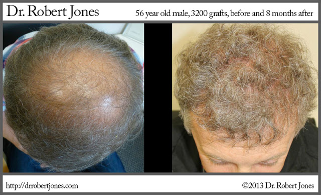 56 Year Old Male – 3200 Grafts Strip Surgery – 8 Months Post