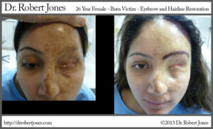 Burn Victims Stunning Eyebrow And Hairline Restoration