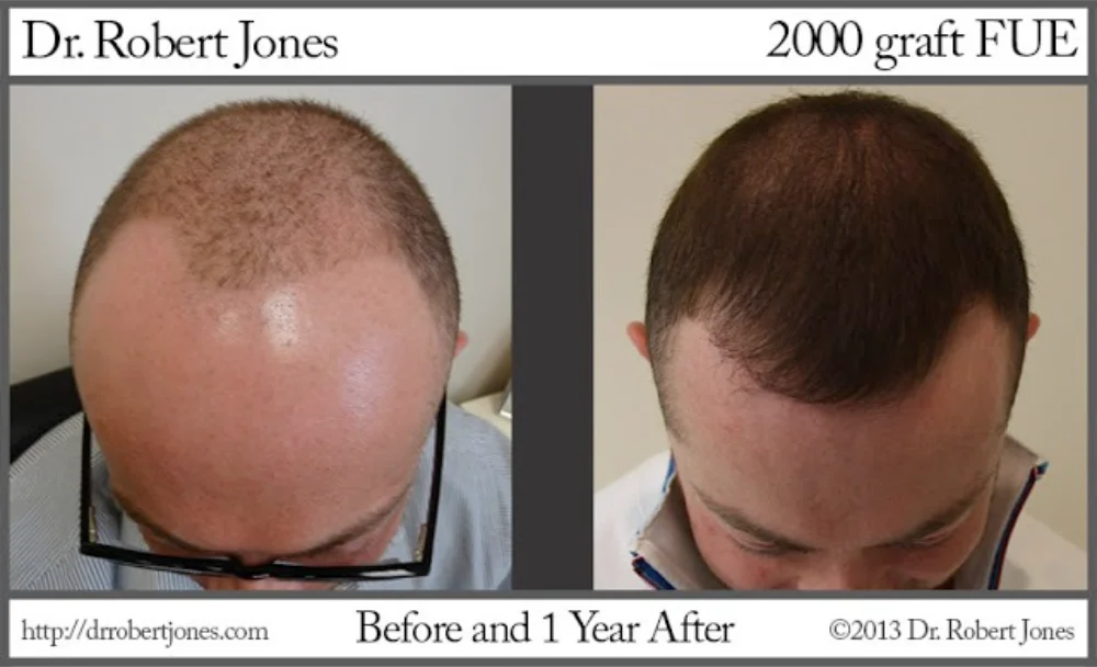 2000 Graft FUE Miraculous Hairline Transition 