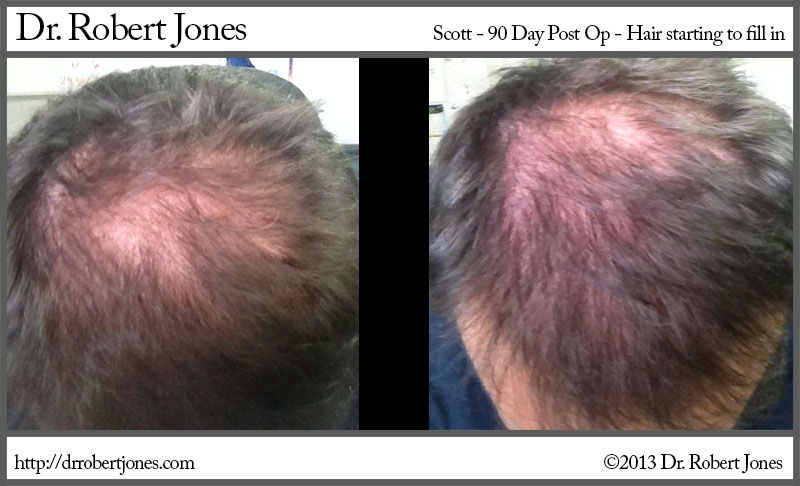 90 days Post Op - Hair Transplant  Jones