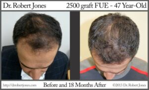 2500 Graft FUE Before and After