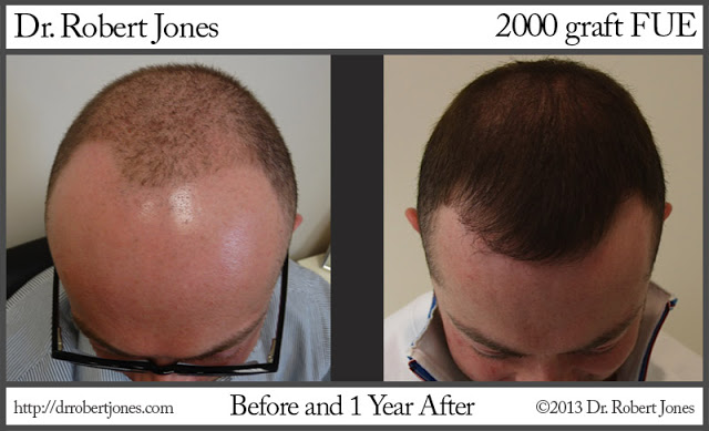Miraculous Hairline Transition from 2000 Graft FUE  Jones