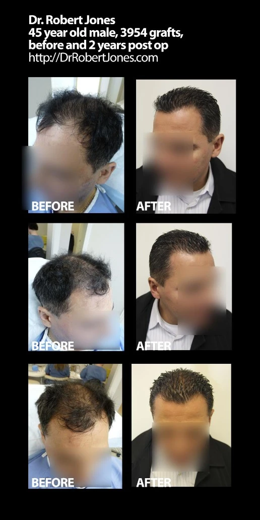 45 Year Old Male 3954 Grafts Before and 2 Years Post Op