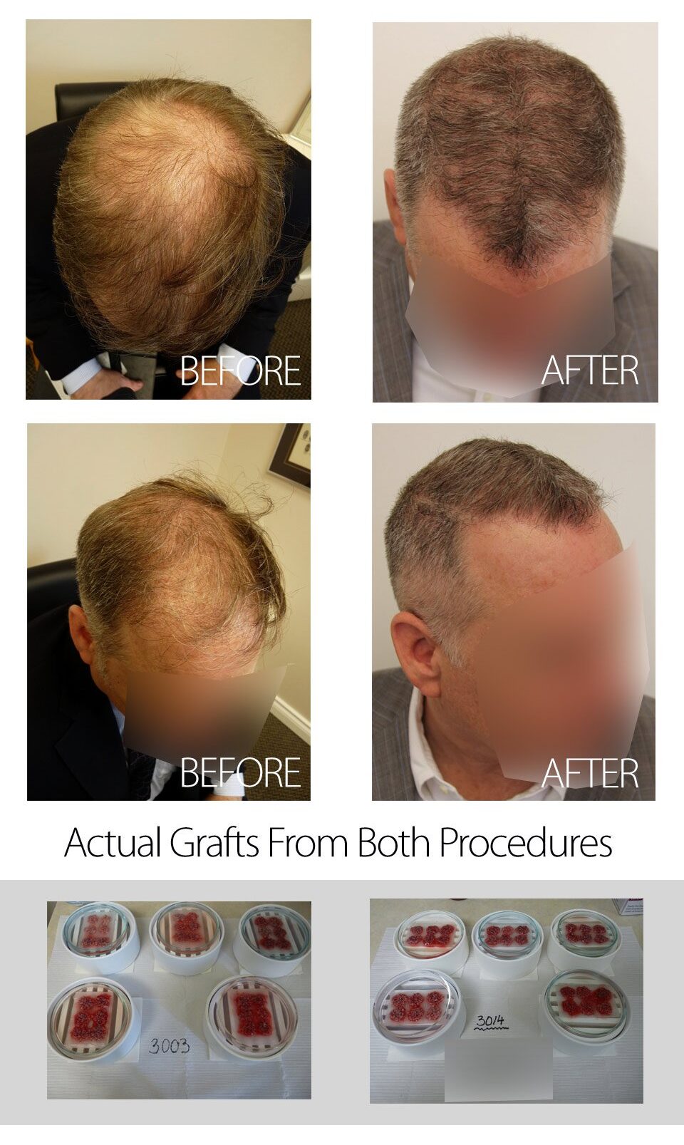 45 yr old post two 3000 graft FUE surgeries in March and October 2013