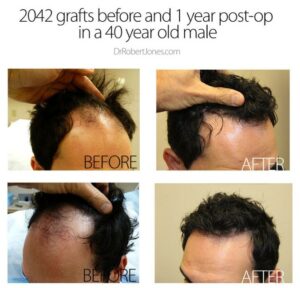 2042 Graft Before And After Hair Transplant