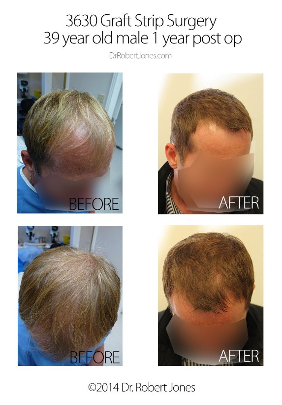 3630 Graft FUE Before And After