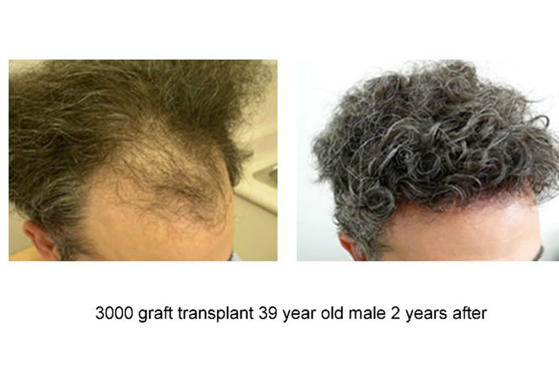 3000 Graft Procedures Performed By Dr.Jones