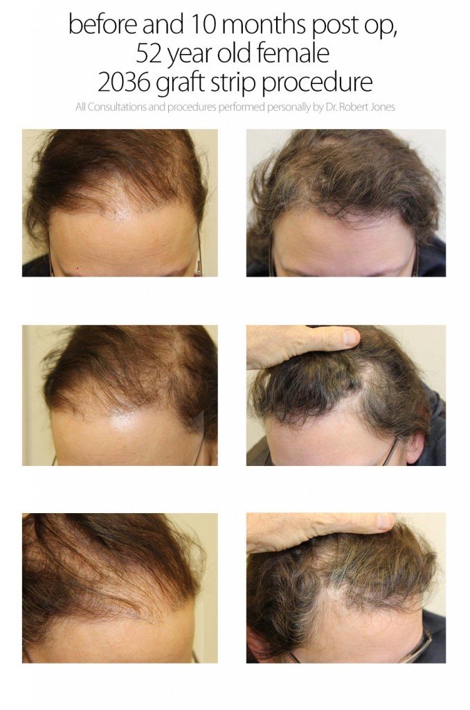 Female Hair Transplant - 2036 grafts - Age 52 | Dr. Robert Jones