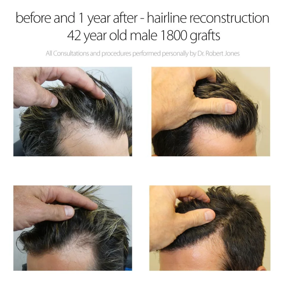 Dr Jones 1800 Graft Hairline Reconstruction