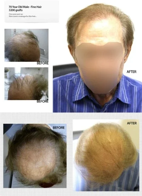 70 Year Old Male 3200 Grafts Fine Hair 70 Year Old Male 3200 Grafts Fine Hair