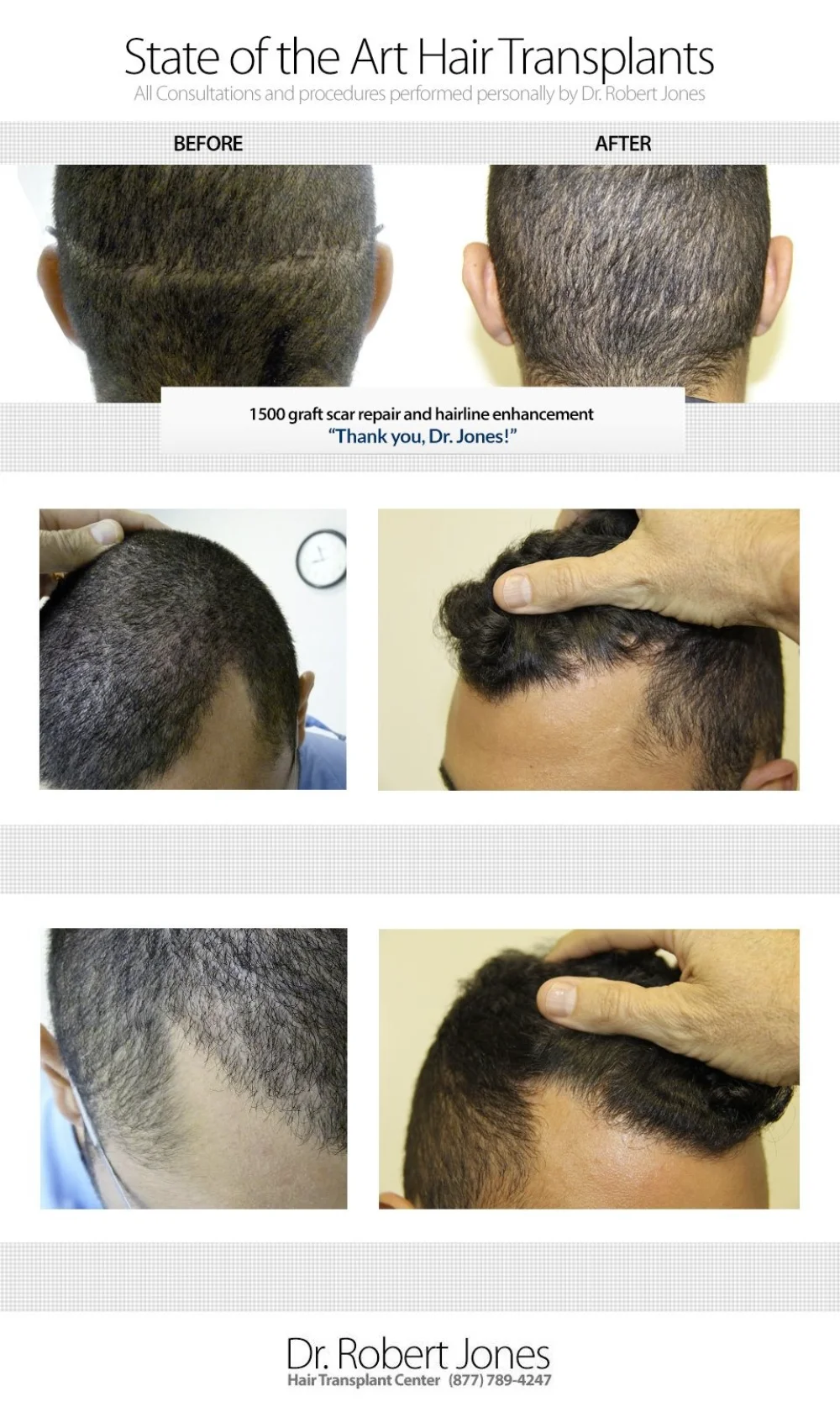 1500 Graft Scar Repair And Hairline