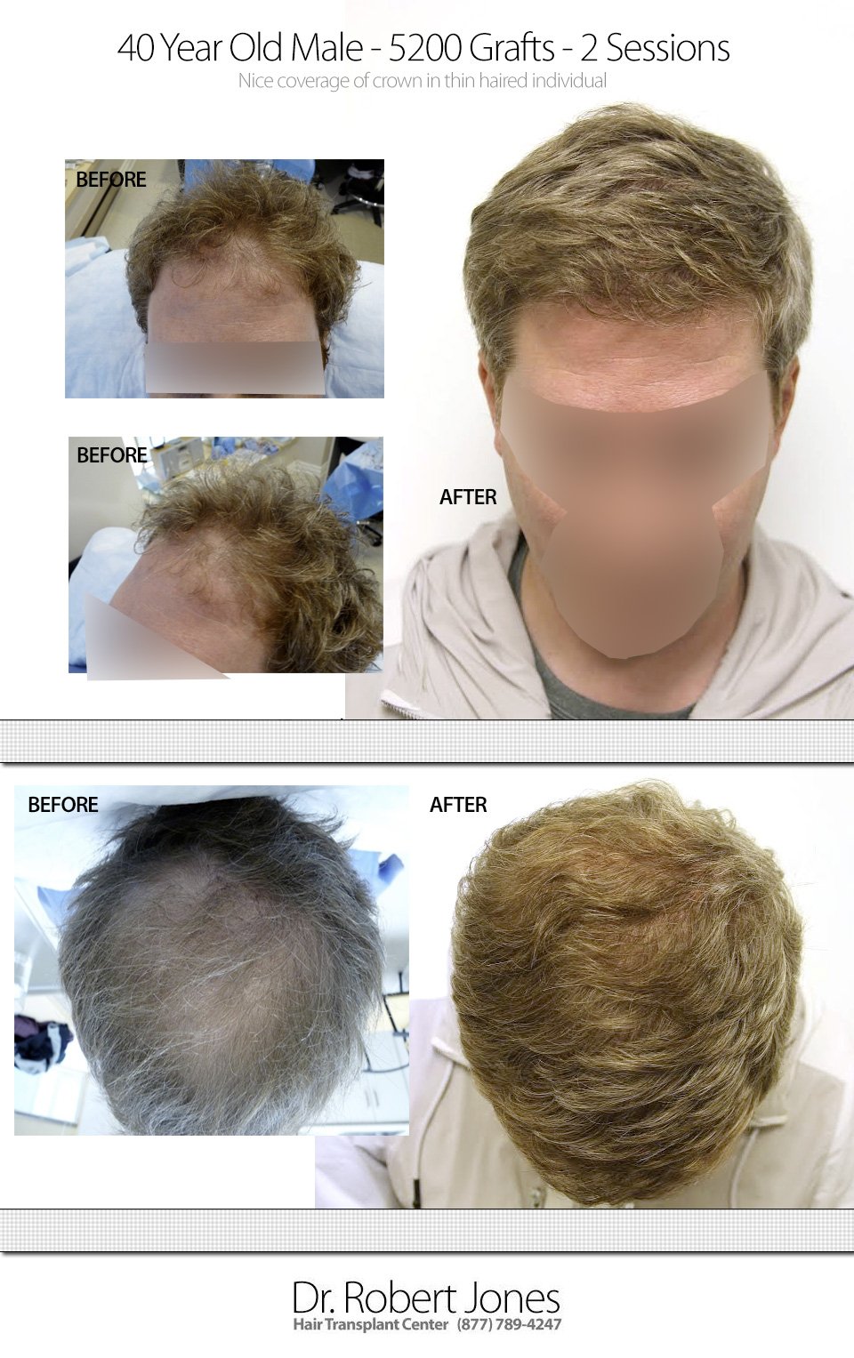 2014-10-22-dr-jones-5200-grafts-thin-hair-male-40-img-1