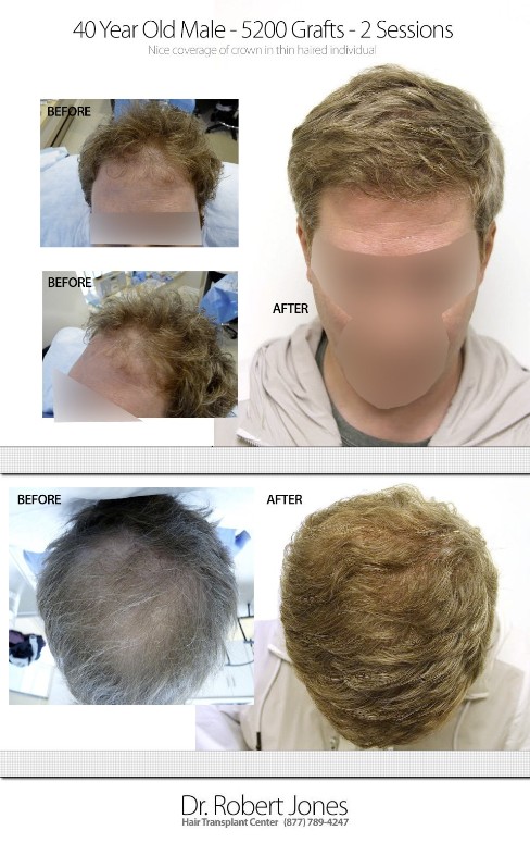 40 Year Old Male 5200 Graft Hair Transplant