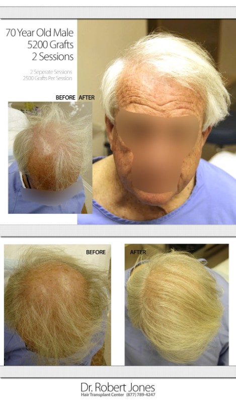 70 Year Old Patient – 5200 Grafts Before and After