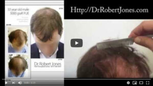 3000 Graft FUE Before And After