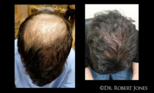 3000 Graft FUE Hair Transplant before and After