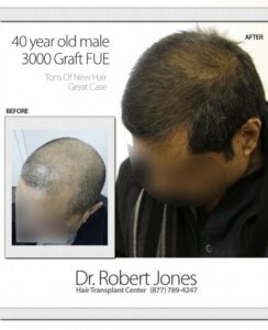 40 Year Old Male 3000 Graft FUE Before And After