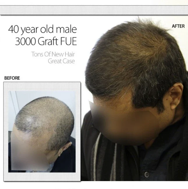 40 Year Old Male 3000 Graft FUE 40 Year Old Male 3000 Graft FUE