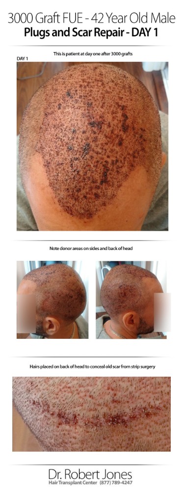 3000 Graft FUE 42 Years Old Male Before and After Day 1