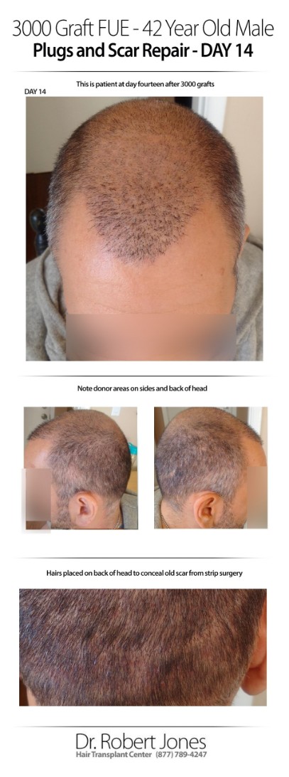 3000 Graft FUE 42 Years Old Male Before and After Day 14