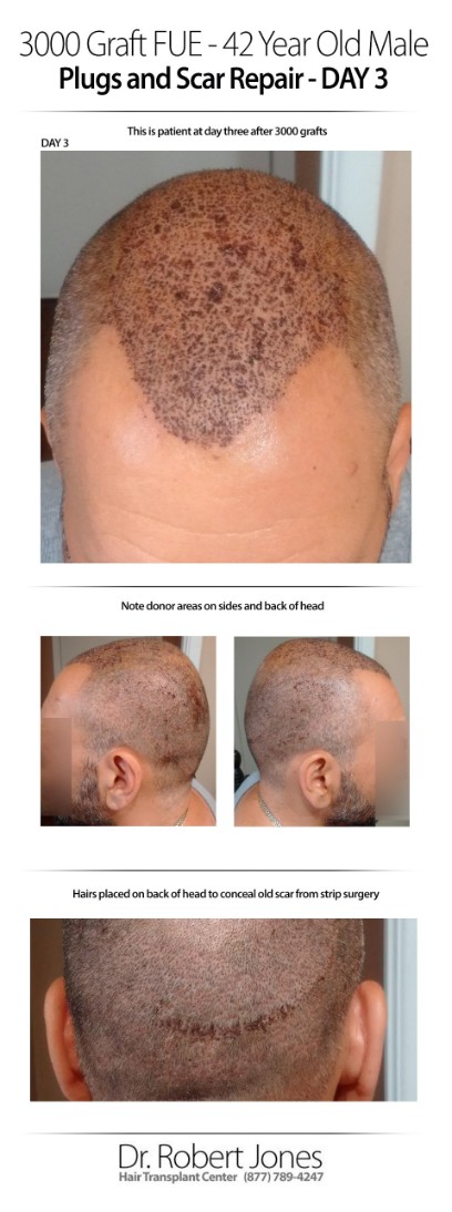 3000 Graft FUE 42 Years Old Male Before and After Day 3
