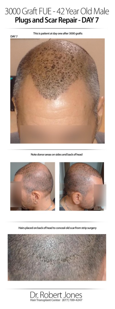 3000 Graft FUE 42 Years Old Male Before and After Day 7
