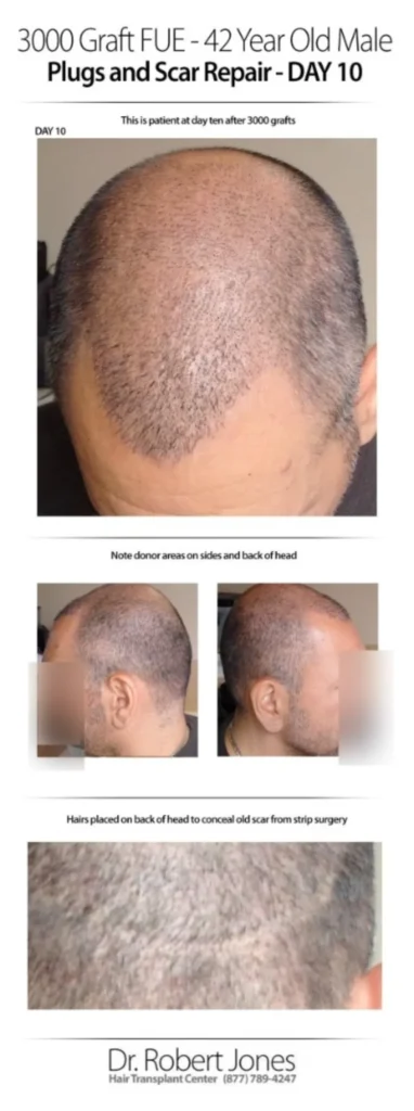 3000 Graft FUE 42 Years Old Male Before And After Day-10