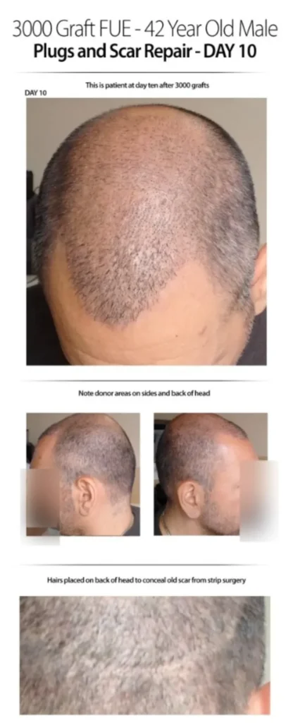 3000 Graft FUE 42 Years Old Male Before And After Day-10